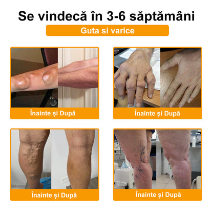 ArthroFree™ Venin de albine Cremă Terapeutică Analgezică🐝(în mod special pentru adulți mai în vârstă & SRCT recomandă)