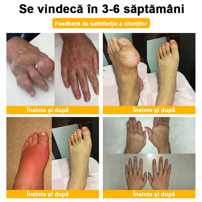 ArthroFree™ Venin de albine Cremă Terapeutică Analgezică🐝(în mod special pentru adulți mai în vârstă & SRCT recomandă)